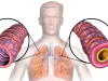 Найдено недостающее звено патогенеза тяжелой астмы
